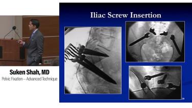 slide iamge from video Neuromuscular Scoliosis: Pelvic Fixation – A Master’s Technique with Suken Shah, MD