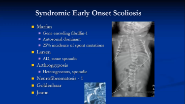 Early Onset Scoliosis: Scope of Problem & Non-operative Treatment with Suken Shah, MD