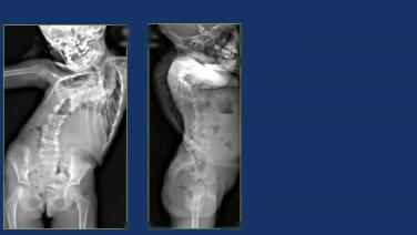 X-ray of a spine from Early Onset Scoliosis: Staying Out of Traction Trouble! with Firoz Miyanji, MD