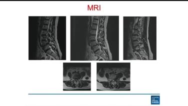 of a X-ray of a spine from Pushing the Boundaries of MIS Surgery - Andrew Sama MD