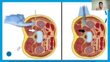 slide from OR Setup & Navigation - Best Practices for Lateral Fusion with Jang Yoon MD