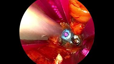 Procedure step from MIS Prone Lateral Procedural Workflow with Shirvinder Wijesekera, MD