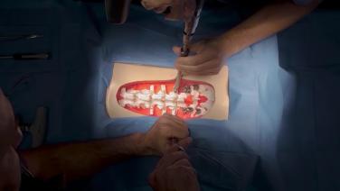 open spine from Posterior Reduction Technique for Lumbar Spondylolisthesis with Nima Alan, MD & Alekos Theologis, MD
