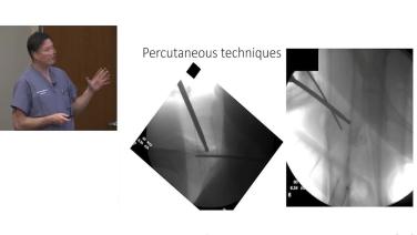X-ray image from By the end of this video, you will be able to describe the surgical technique steps for reducing a peritrochanteric hip fractures.