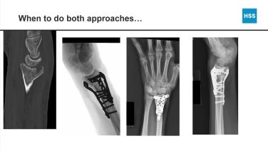 Hand and Wrist x-ray from "Distal Radius Fractures: Treatment and Surgical Management with Aaron Daluiski, MD & Amy Speeckaert, MD"