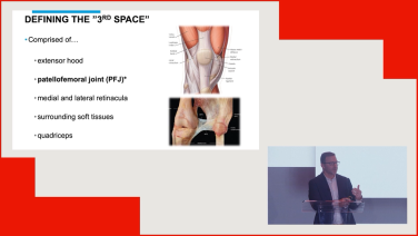 Managing the Third Space in Total Knee Arthroplasty - Kevin Perry MD