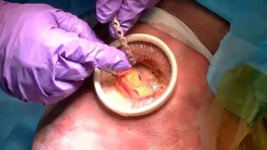 open chest from Rib Fixation Approaches with Nir Hus, MD