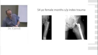 Periprosthetic Fractures Vancouver B Classification with Eben Carroll, MD