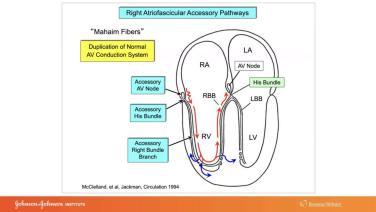 An Image From "Use of ECG and Intracardiac Recordings to Diagnose and Demonstrate the Electrophysiologic Characters of Atriofascicular and Atroventricular Type "Mahaim" Fibers with Warren 'Sonny' Jackman, MD"