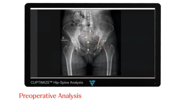 An Image From "EMPHASYS™ Acetabular Procedural Solutions: Anterior Approach with Colin Mudrick, MD"