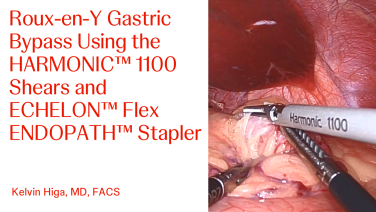 An Image From "Roux-en-Y Gastric Bypass Using the HARMONIC™ 1100 Shears and ECHELON™ Flex ENDOPATH™ Stapler with Kelvin Higa, MD"