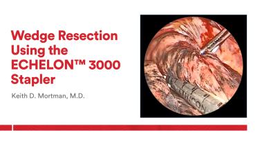 An Image From "Wedge Resection Using the ECHELON™ 3000 Stapler with Keith Mortman, MD"
