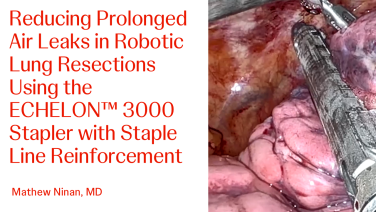 An Image From "Reducing Prolonged Air Leaks in Robotic Lung Resections Using the ECHELON™ 3000 Stapler with Staple Line Reinforcement with Mathew Ninan, MD"