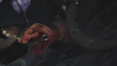 Procedure step from Total Knee Arthroplasty using ATTUNE™ Revision Cones- Procedural Workflow with Timothy Alton, MD