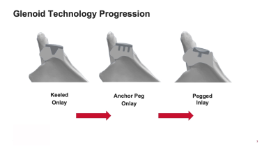 INHANCE Shoulder System: Anatomic Glenoid thumbnail
