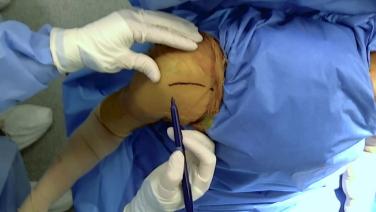Overhead view of the procedure from Anatomic Total Shoulder Procedural Workflow with Luke Austin, MD