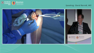 Unicompartmental Knee Procedural Workflow - David Barrett, MD & David Dalury, MD thumbnail image