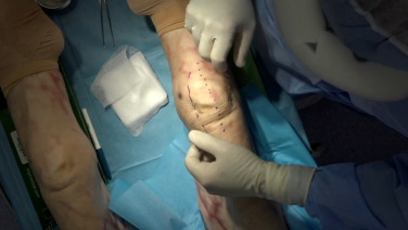 Unicompartmental Knee Procedural Workflow with INTUITION Instruments - David Dalury, MD thumbnail