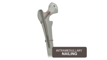 A graphic of a hip bone with the nails repairing the fracture from the Hip Fracture Nailing video