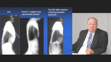 An image of the "Overview of Surgical Treatments for Patients with Neuromuscular Scoliosis with Randal Betz, MD" video.