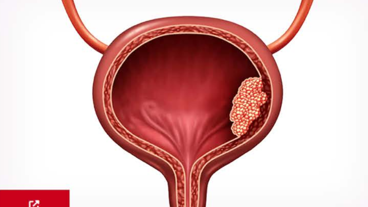 An Image From "Non–Muscle-Invasive Bladder Cancer (NMIBC)"