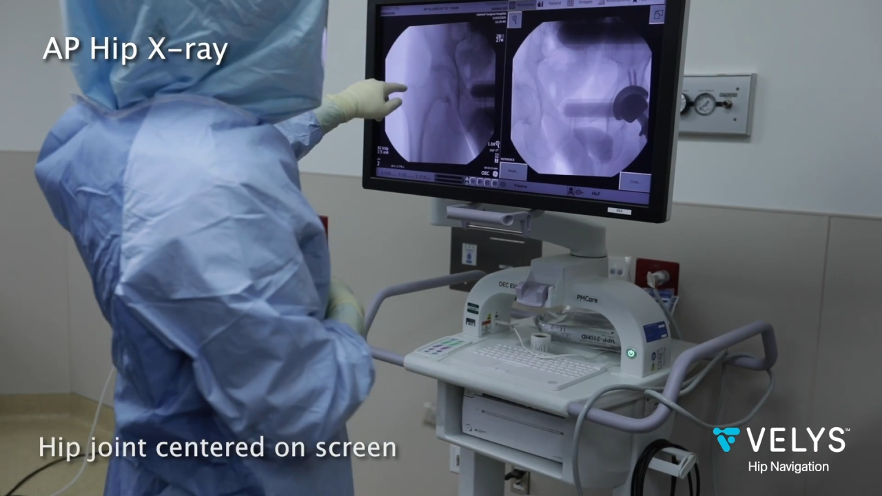 image from VELYS Hip Navigation Posterior Arthroplasty - Brent Carlson, MD