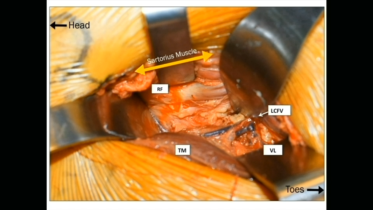 Image from Function Anatomy for Anterior Approach Total Hip Arthroplasty - Tania Ferguson, MD